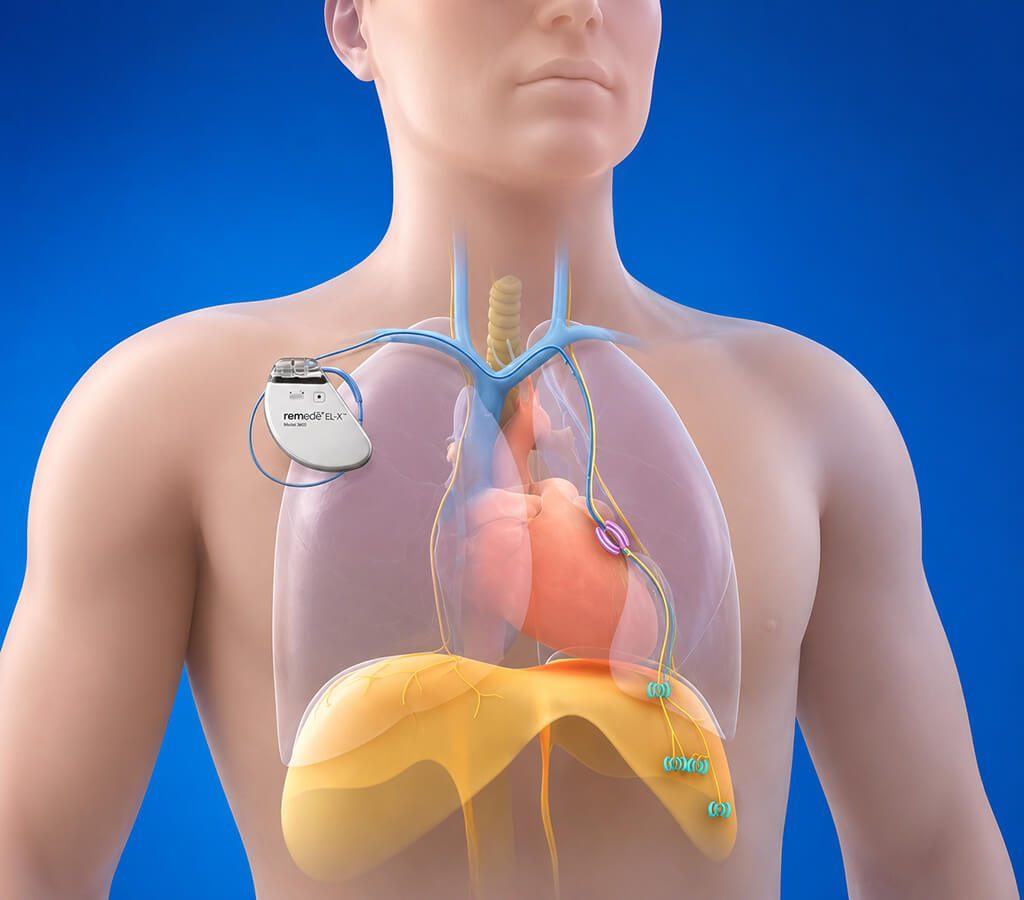 3D medical render of the remedē EL-X phrenic nerve stimulator implanted in the chest with leads activating the diaphragm for central sleep apnea