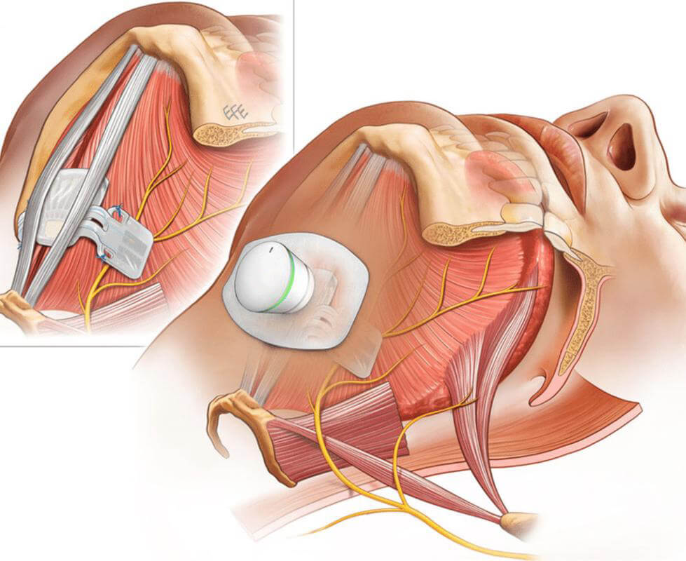 Medical illustration of a submental sleep apnea stimulation patch and internal hypoglossal nerve electrode placement