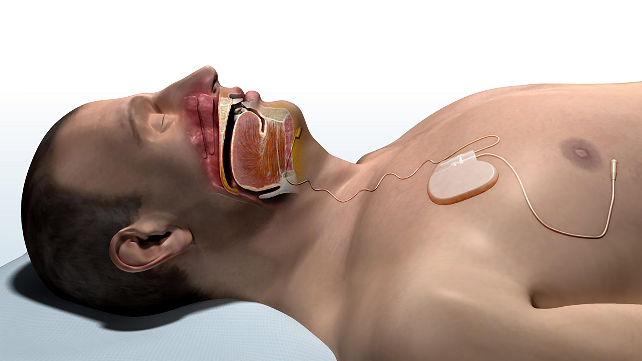 3D medical illustration of a sleep apnea hypoglossal nerve stimulator implanted in a patient's chest with leads connected to the airway and ribs