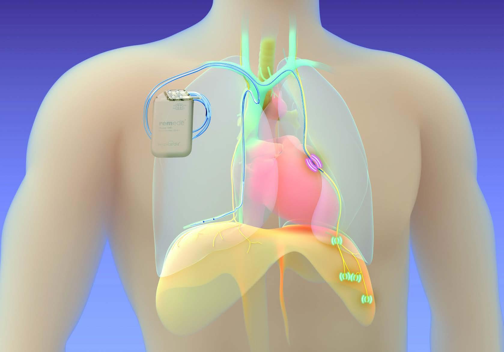 Medical illustration of a phrenic nerve stimulation implant for central sleep apnea